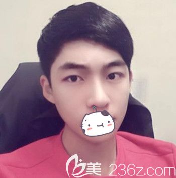 在韩国JJ洪镇柱整形外科做面部轮廓+眼鼻整形手术后3个月 在韩国JJ洪镇柱整形外科做面部轮廓+眼鼻整形手术后3个月