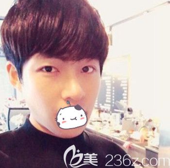 在韩国JJ洪镇柱整形外科做面部轮廓+眼鼻整形手术后6个月 在韩国JJ洪镇柱整形外科做面部轮廓+眼鼻整形手术后6个月