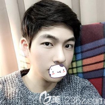 公开我在韩国JJ洪镇柱整形外科做面部轮廓+眼鼻整形手术后1年的后记