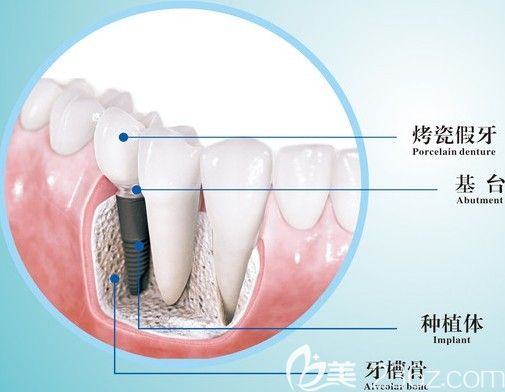 上海亿大口腔张睿博士介绍种植牙