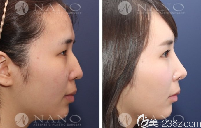 公开韩国Nano整形外科赵重衍隆鼻案例
