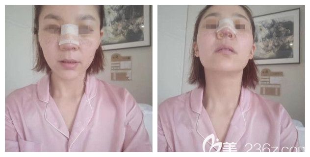 刚做完半肋软骨隆鼻术后即刻恢复 刚做完半肋软骨隆鼻术后即刻恢复