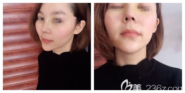 找顾陆健医生做半肋软骨隆鼻术后6天拆线恢复 找顾陆健医生做半肋软骨隆鼻术后6天拆线恢复