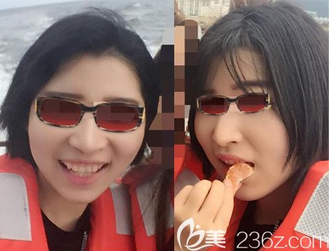 韩国釜山哈娜尔整形医院金成浩院长颧骨内推真人案例 韩国釜山哈娜尔整形医院金成浩院长颧骨内推真人案例