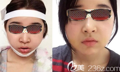 韩国釜山哈娜尔整形金成浩颧骨内推术后6天恢复效果图 韩国釜山哈娜尔整形金成浩颧骨内推术后6天恢复效果图