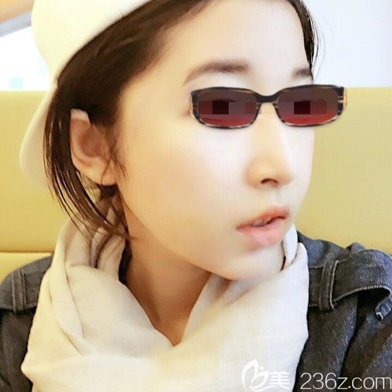 韩国釜山哈娜尔金成浩面部轮廓案例术后12天恢复效果图 韩国釜山哈娜尔金成浩面部轮廓案例术后12天恢复效果图