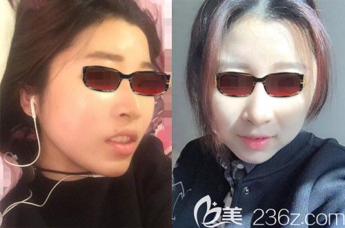 整颧骨韩国哪个医生好？我找韩国釜山哈娜尔整形金成浩做颧骨内推4个月恢复效果图