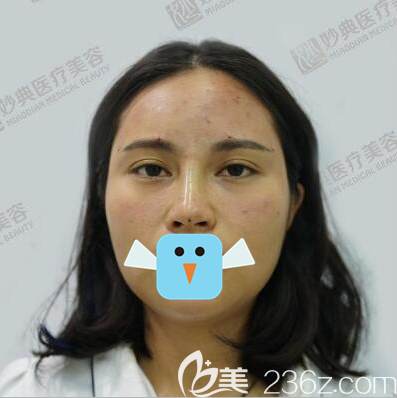 加维拉斯鼻雕+全脸鲜活细胞填充术后照片