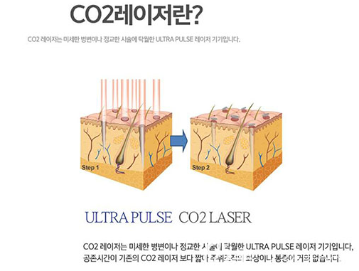韩国欧琳娜olina医院CO2皮肤治疗特色示意图