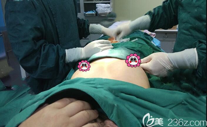 自体脂肪填充丰胸手术中 自体脂肪填充丰胸手术中