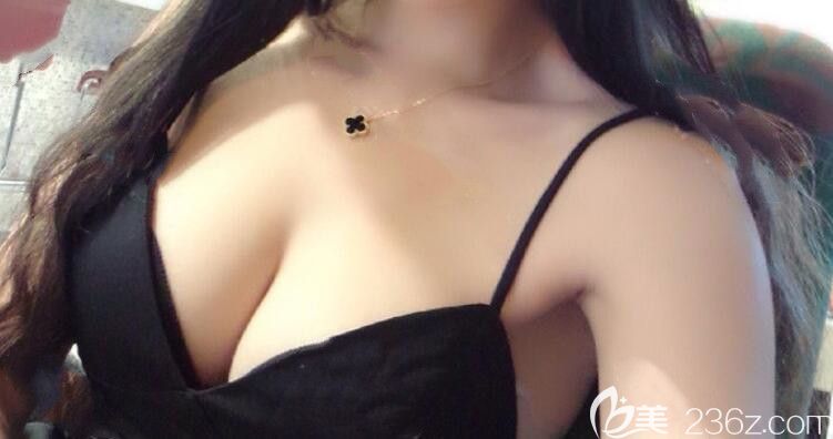 合肥福华整形自体脂肪隆胸术后第14天 合肥福华整形自体脂肪隆胸术后第14天