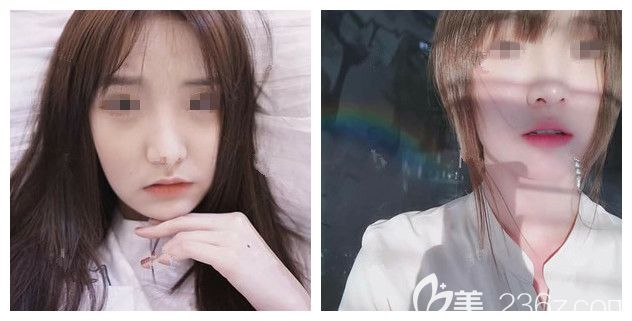 面诊扬州美贝尔医生术前国字脸 面诊扬州美贝尔医生术前国字脸