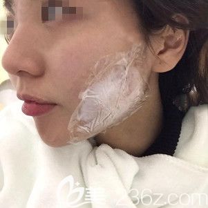 涂抹过麻醉膏后注射瘦脸 涂抹过麻醉膏后注射瘦脸