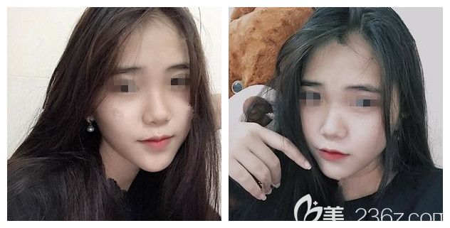 注射瘦脸术后一个月效果 注射瘦脸术后一个月效果