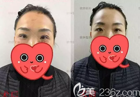 <!--<i data=20240703-sp></i>-->双眼皮修复术前术后对比照片 <!--<i data=20240703-sp></i>-->双眼皮修复术前术后对比照片