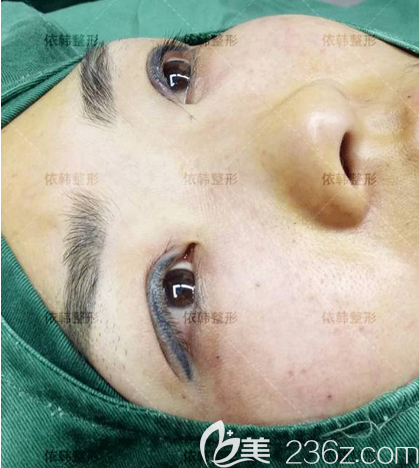 <!--<i data=20240703-sp></i>-->双眼皮修复术后即刻照片 <!--<i data=20240703-sp></i>-->双眼皮修复术后即刻照片