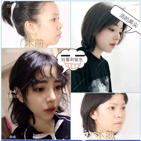 贵阳美莱梁洁隆鼻怎么样 贵阳美莱梁洁隆鼻怎么样