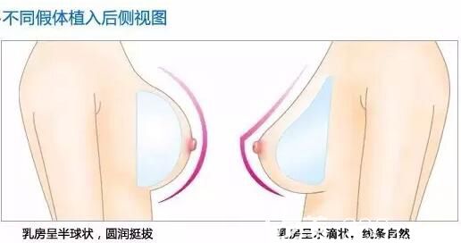 不同隆胸假体植入后的形状效果