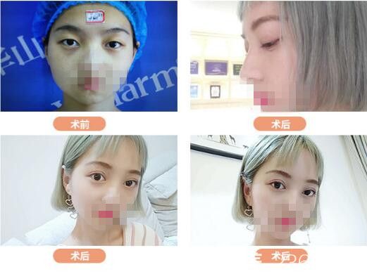 胡斌医生眼综合整形案例