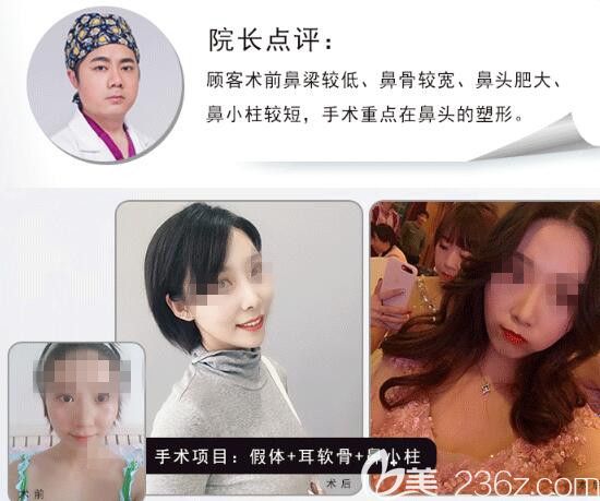 胡斌医生鼻综合整形案例