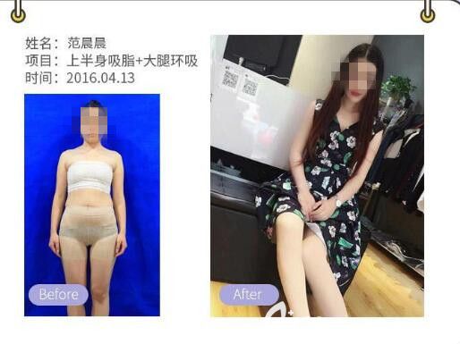 胡瑞芬医生吸脂减肥案例