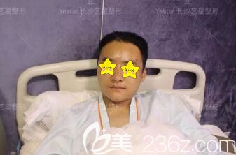 做自体脂肪填充面部术后第1天效果图