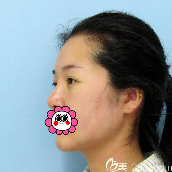 哈尔滨索菲内路祛眼袋后第二天 哈尔滨索菲内路祛眼袋后第二天