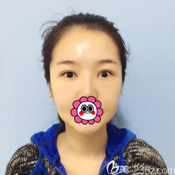 哈尔滨索菲内路祛眼袋恢复半个月后 哈尔滨索菲内路祛眼袋恢复半个月后