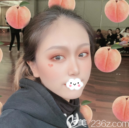 鼻综合隆鼻术后半个月恢复效果图