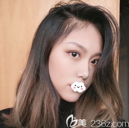 东莞维多利亚隆鼻案例一个月效果图片