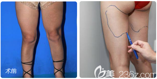在广州中家医家庭医生做大腿吸脂术前照片 在广州中家医家庭医生做大腿吸脂术前照片