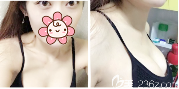 曼托假体隆胸术后20天拆线效果