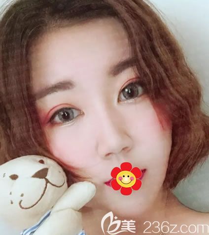 绍兴维美隆鼻案例15天效果图