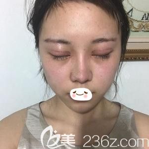 在邯郸雅丽做双眼皮失败修复术后7天进行拆线