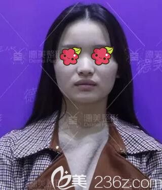 做肋软骨复合隆鼻术前照 做肋软骨复合隆鼻术前照