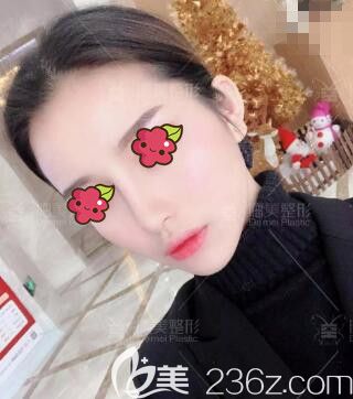 在邵阳德美做肋软骨复合隆鼻术后半个月效果 在邵阳德美做肋软骨复合隆鼻术后半个月效果