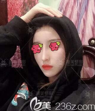 做完肋软骨复合隆鼻术后1个月时的恢复程度 做完肋软骨复合隆鼻术后1个月时的恢复程度