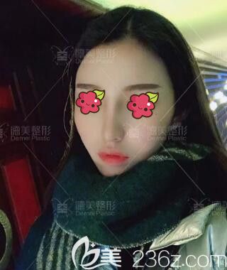 做完肋软骨复合隆鼻术后2个月时的效果 做完肋软骨复合隆鼻术后2个月时的效果