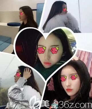 邵阳德美是正规医院么？用我找李倩做的肋软骨复合隆鼻术后3个月恢复效果图告诉你！