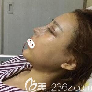 医美圈 | 韩国研究：硅胶隆鼻术后包膜挛缩发病机制分析硅胶假体隆鼻可以一辈子不取吗