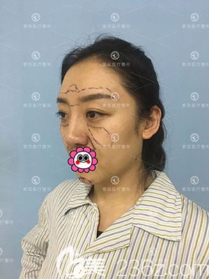哈尔滨索菲做自体脂肪填充前设计画线 哈尔滨索菲做自体脂肪填充前设计画线