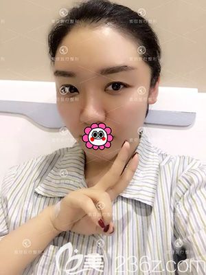 哈尔滨索菲自体脂肪填充面部术后即刻 哈尔滨索菲自体脂肪填充面部术后即刻