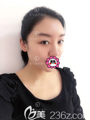 自体脂肪填充面部术后一周效果明显改善 自体脂肪填充面部术后一周效果明显改善