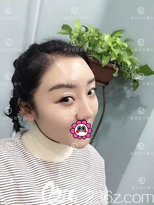 自体脂肪面部填充术后20天效果 自体脂肪面部填充术后20天效果