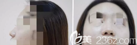 <!--<i data=20240703-sp></i>-->医疗美容门诊部术前隆鼻侧面和正面照片