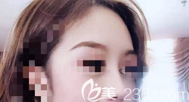 鼻综合术后三个月侧面照片