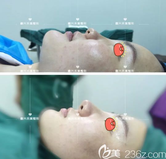 刚做完隆鼻手术效果对比图片