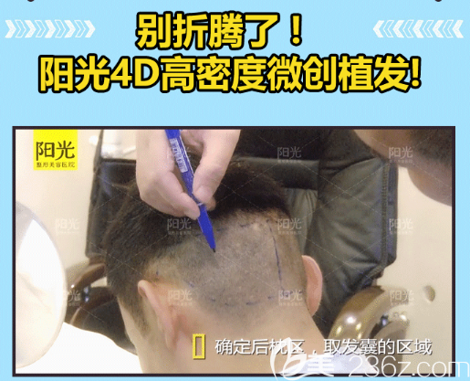 整形医院4D高密度微创植发优势