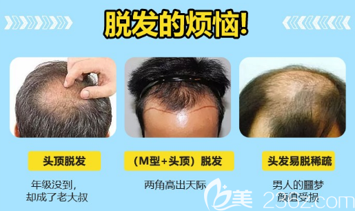 整形医院各种脱发照片
