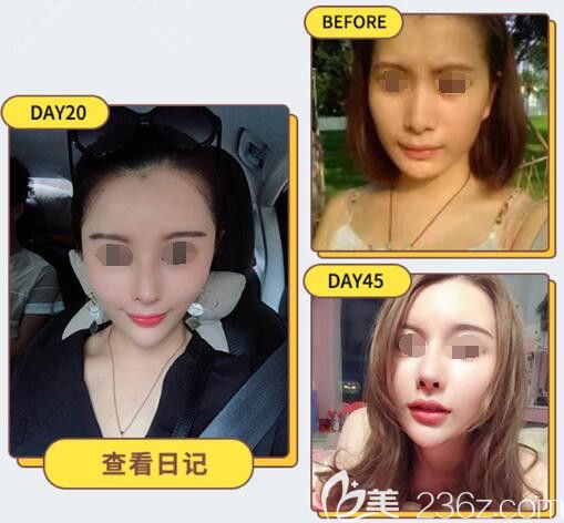 闺蜜到苏州紫馨做的隆鼻案例 闺蜜到苏州紫馨做的隆鼻案例